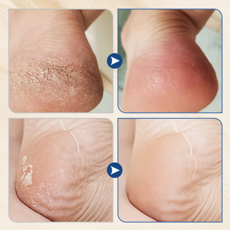 🎉Buy 1 Get 1 Free🎉Hydrating and Anti-Cracking Foot Cream